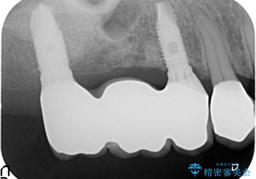 セラミック・インプラント治療を含む包括歯周病治療の治療後