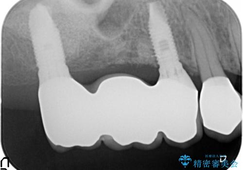 セラミック・インプラント治療を含む包括歯周病治療の治療後