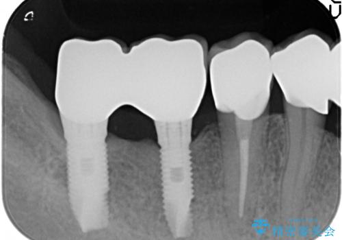 セラミック・インプラント治療を含む包括歯周病治療の治療後