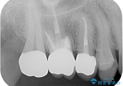 目立つ銀歯と欠けてしまった詰め物 オールセラミッククラウンでの補綴治療の治療後