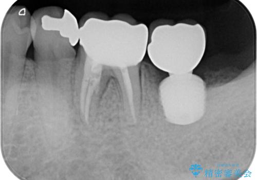 奥歯が痛い　破折した奥歯のインプラント治療の治療後