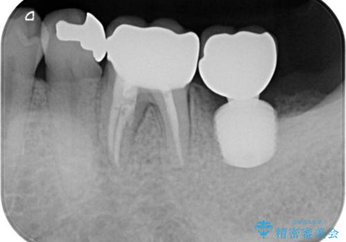 奥歯が痛い 破折した奥歯のインプラント治療の治療後
