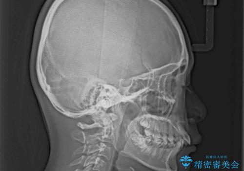 飛び出した前歯と八重歯を改善　ワイヤー装置での抜歯矯正の治療前