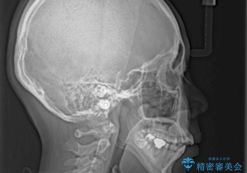 開咬と前突を改善 ワイヤー装置での抜歯矯正の治療前