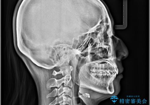上顎前突をしっかりと治す 補助装置を使用したワイヤー矯正の治療後