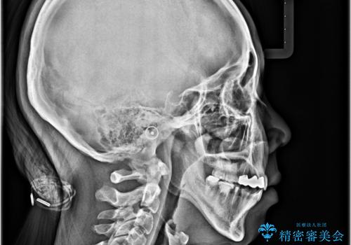 開咬と前突を改善 ワイヤー装置での抜歯矯正の治療後