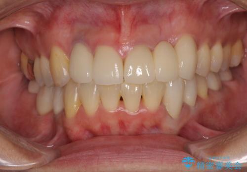 非対称の前歯を整えたい 矯正治療と審美治療の総合歯科診療の症例 治療後