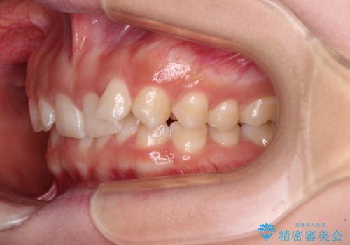 ディープバイトを短期間で改善 ワイヤー矯正治療の治療前