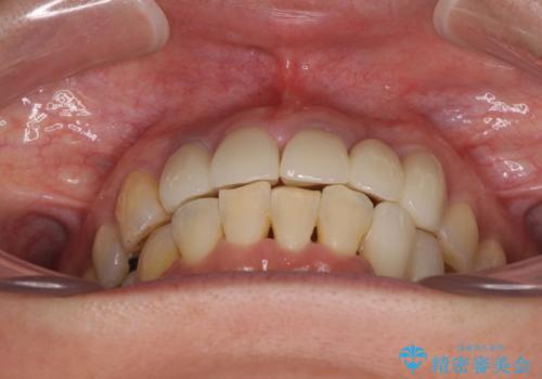 非対称の前歯を整えたい 矯正治療と審美治療の総合歯科診療の治療後