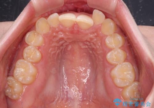 ディープバイトを短期間で改善 ワイヤー矯正治療の治療前