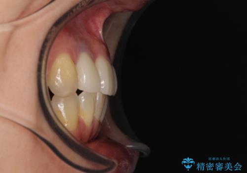非対称の前歯を整えたい 矯正治療と審美治療の総合歯科診療の治療後