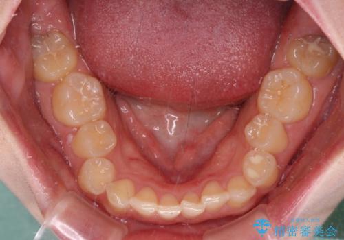 ディープバイトを短期間で改善 ワイヤー矯正治療の治療前