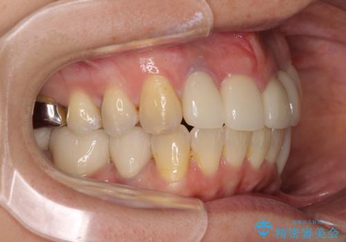 非対称の前歯を整えたい 矯正治療と審美治療の総合歯科診療の治療後