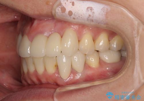 非対称の前歯を整えたい 矯正治療と審美治療の総合歯科診療の治療後