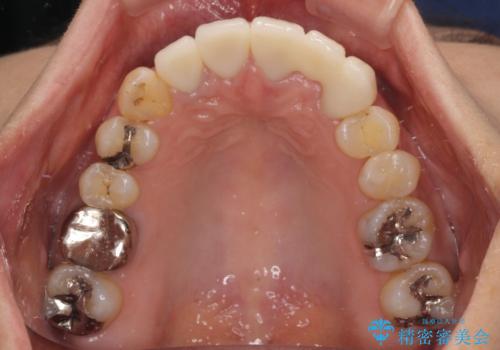 非対称の前歯を整えたい 矯正治療と審美治療の総合歯科診療の治療後