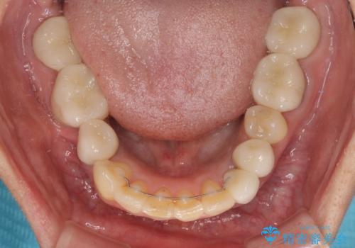非対称の前歯を整えたい 矯正治療と審美治療の総合歯科診療の治療後