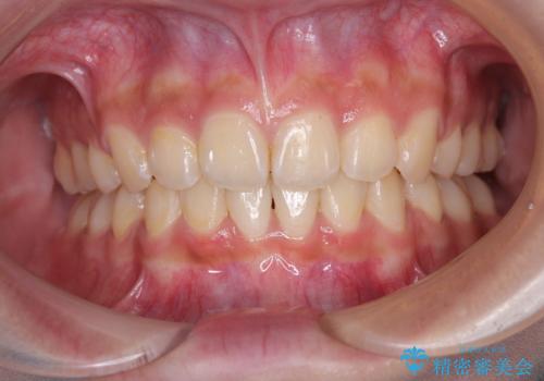 飛び出した前歯と八重歯を改善 ワイヤー装置での抜歯矯正の症例 治療後