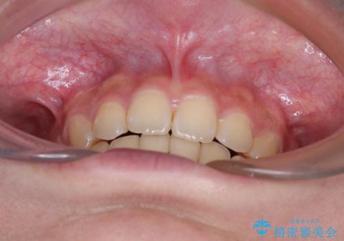 飛び出した前歯と八重歯を改善 ワイヤー装置での抜歯矯正の治療後