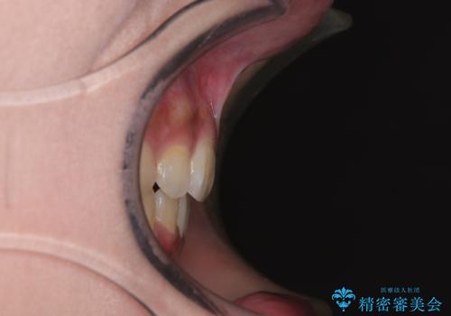 飛び出した前歯と八重歯を改善　ワイヤー装置での抜歯矯正の治療後