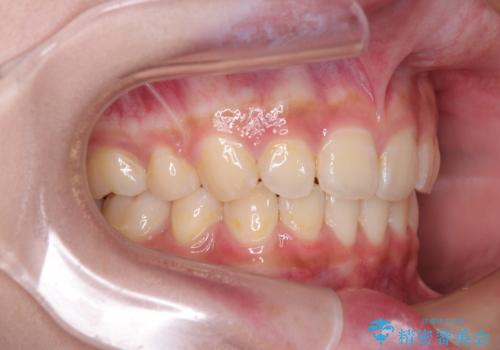 飛び出した前歯と八重歯を改善　ワイヤー装置での抜歯矯正の治療後