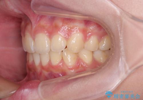 飛び出した前歯と八重歯を改善　ワイヤー装置での抜歯矯正の治療後
