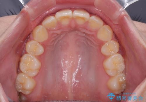 飛び出した前歯と八重歯を改善　ワイヤー装置での抜歯矯正の治療後