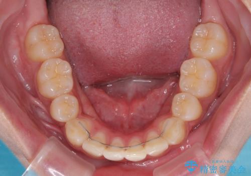 飛び出した前歯と八重歯を改善　ワイヤー装置での抜歯矯正の治療後