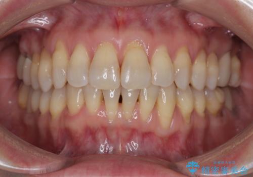 マウスピース矯正とセラミック治療で綺麗な口元にの症例 治療後