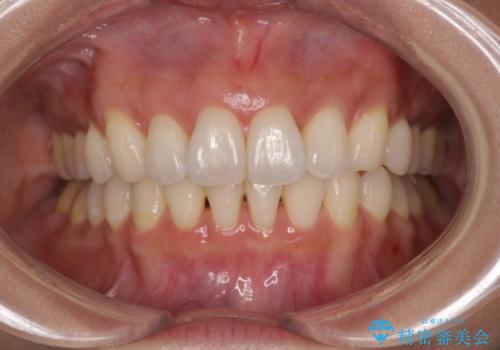 上顎前突をしっかりと治す 補助装置を使用したワイヤー矯正の症例 治療後