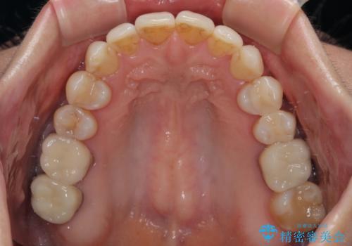 マウスピース矯正とセラミック治療で綺麗な口元にの治療後