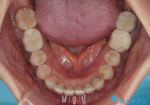 マウスピース矯正とセラミック治療で綺麗な口元にの治療後