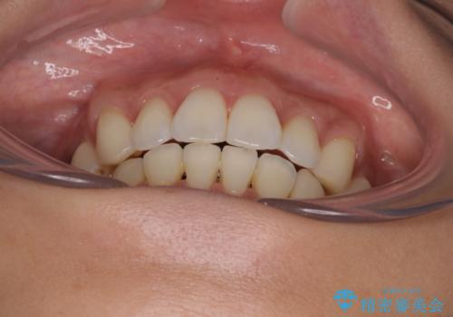 上顎前突をしっかりと治す 補助装置を使用したワイヤー矯正の治療後