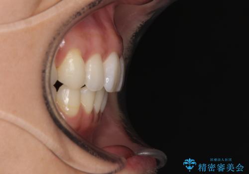 上顎前突をしっかりと治す 補助装置を使用したワイヤー矯正の治療後