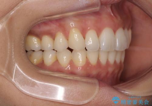 上顎前突をしっかりと治す 補助装置を使用したワイヤー矯正の治療後