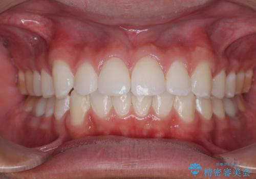 楽してデコボコを治したい ワイヤー矯正治療の症例 治療後