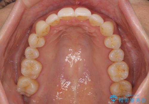 上顎前突をしっかりと治す 補助装置を使用したワイヤー矯正の治療後