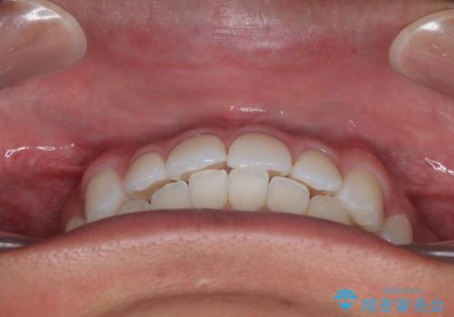 楽してデコボコを治したい ワイヤー矯正治療の治療後