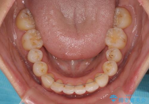 上顎前突をしっかりと治す 補助装置を使用したワイヤー矯正の治療後