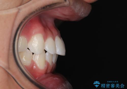 楽してデコボコを治したい ワイヤー矯正治療の治療後