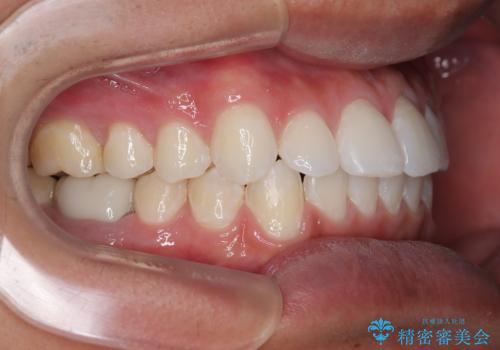 楽してデコボコを治したい ワイヤー矯正治療の治療後