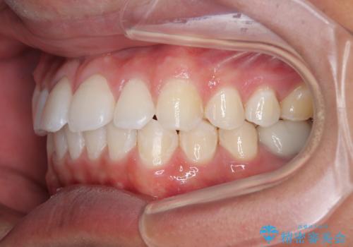 楽してデコボコを治したい ワイヤー矯正治療の治療後