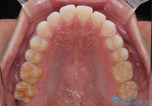 楽してデコボコを治したい ワイヤー矯正治療の治療後