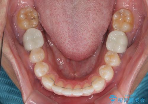 楽してデコボコを治したい ワイヤー矯正治療の治療後