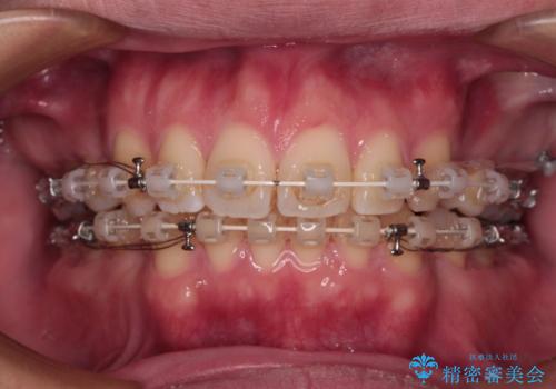 口元が出ているのが気になる。審美装置による抜歯矯正の治療中