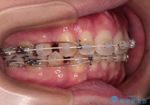 口元が出ているのが気になる。審美装置による抜歯矯正の治療中