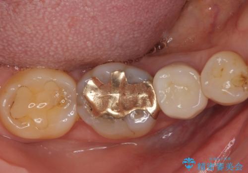 食べ物が引っかかるからやり替えたい セラミックインレー修復の症例 治療前