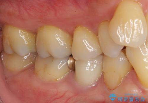 食べ物が引っかかるからやり替えたい セラミックインレー修復の治療前