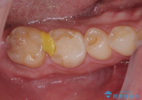 セラミックの詰め物が欠けたのでやり替えたい　オールセラミッククラウンの治療前
