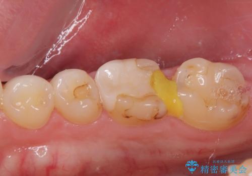 セラミックの詰め物が欠けたのでやり替えたい　オールセラミッククラウンの治療前