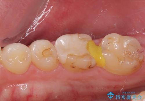 セラミックの詰め物が欠けたのでやり替えたい オールセラミッククラウンの治療前